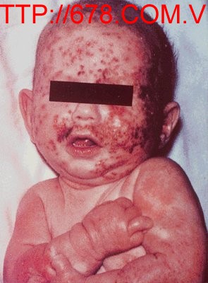 Bệnh nhiễm Herpes simplex